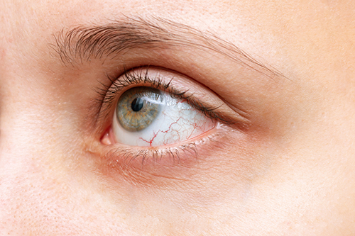 Dry Eye Treatment in Redding