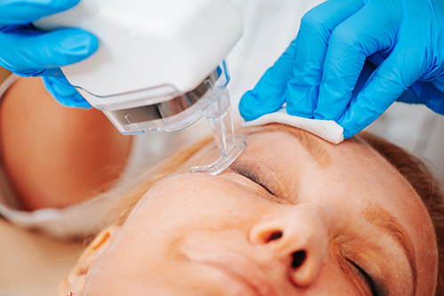 OptiPlus RF Dry Eye Treatment in Redding