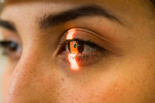 OptiPlus RF Dry Eye Treatment in Redding